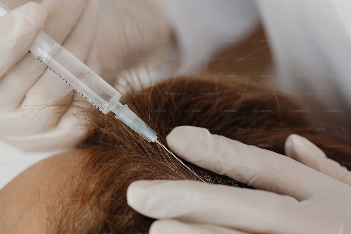 Female hair thinning FUE